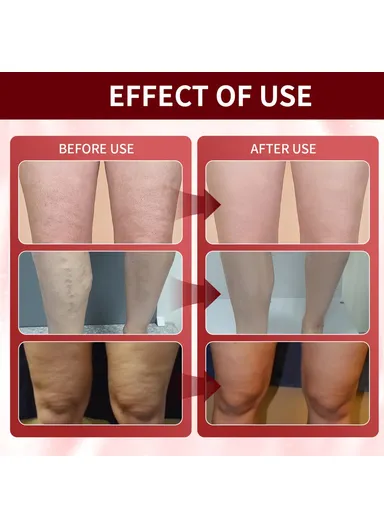 5 Pairs Acupoint Massage Foot Patch Relieve Venous Swelling Foot Care Pad XIA03-A005-5-RD1